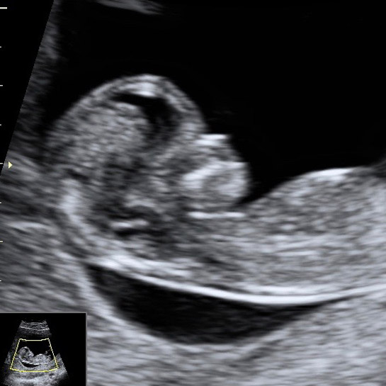 baby measuring small at 12 weeks