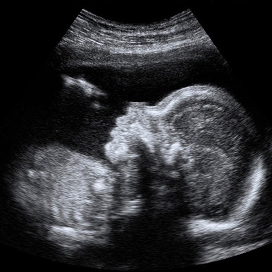 Learner Niende kaste Anomaly Scan - Private 20 week anomaly scan for pregnancy - Beard Mill